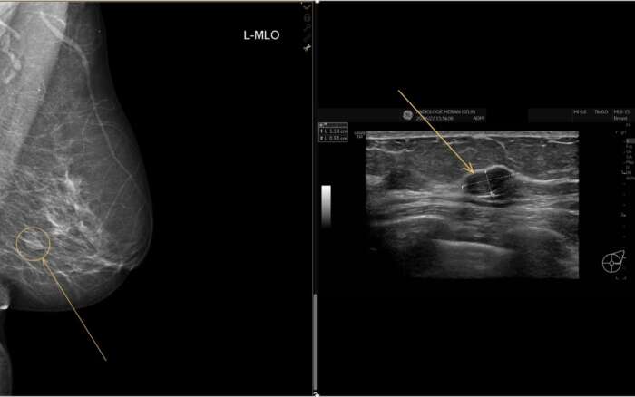 Foto Mammographie und Ultraschall