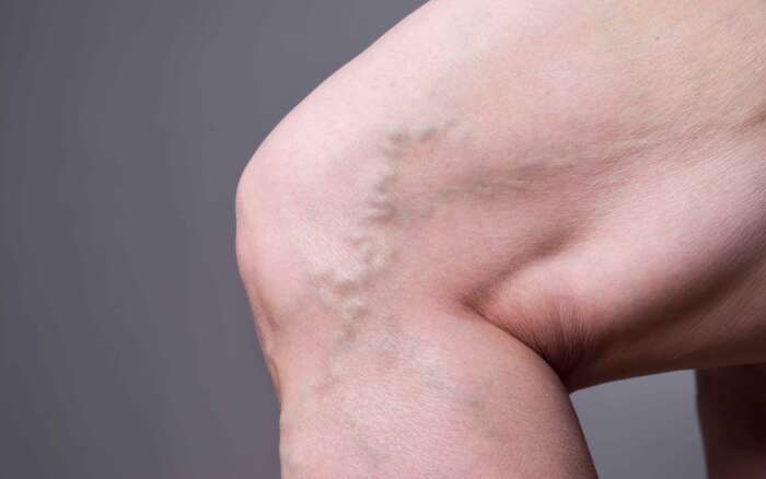 Chirurgie Venen web