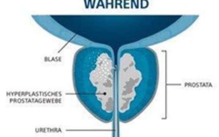 Rezum minimal invasiv
