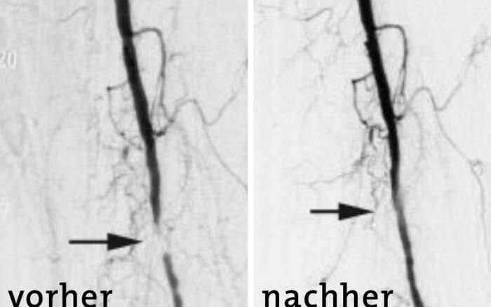 Angiographie 01